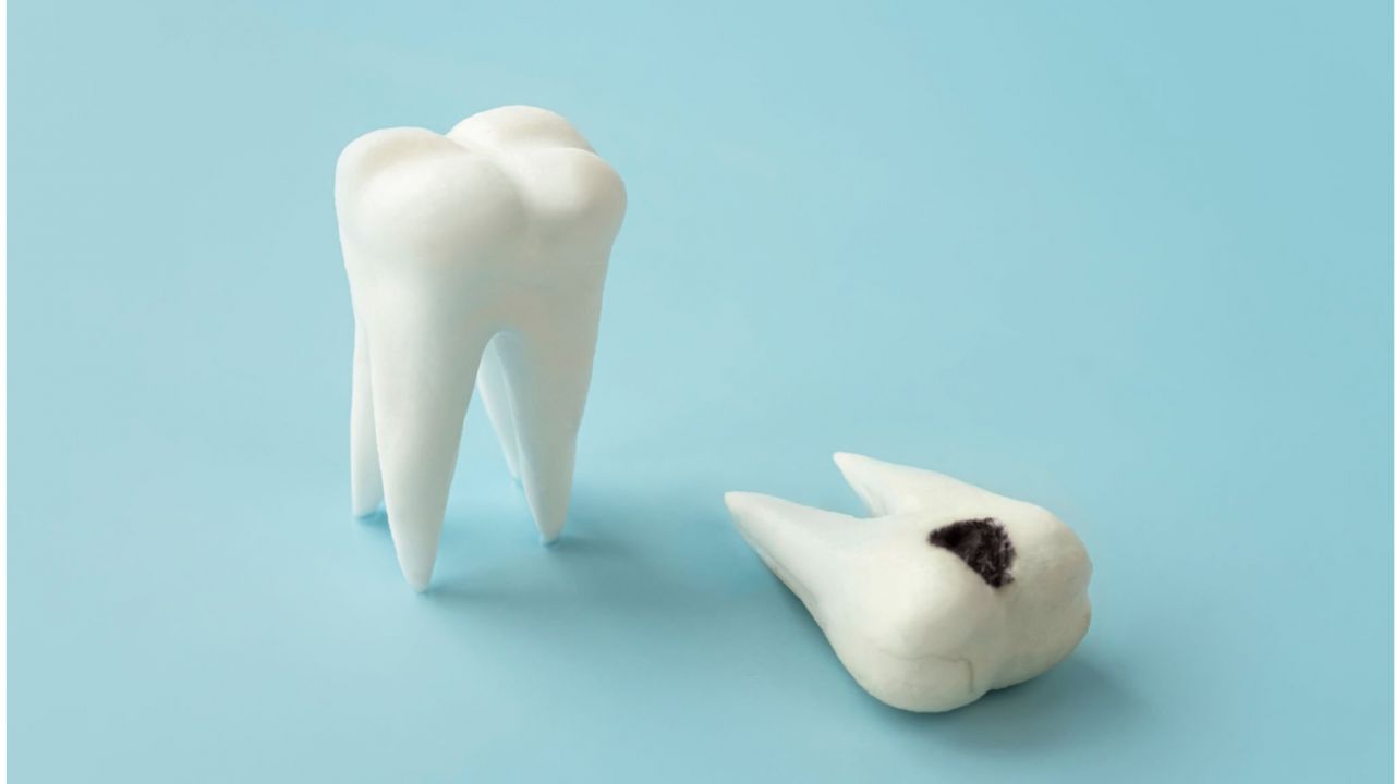 tipos de cáries dentárias