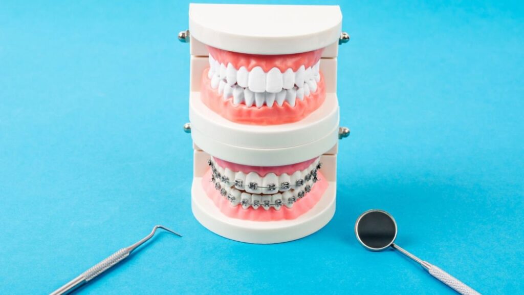 tipos de aparelho ortodontico