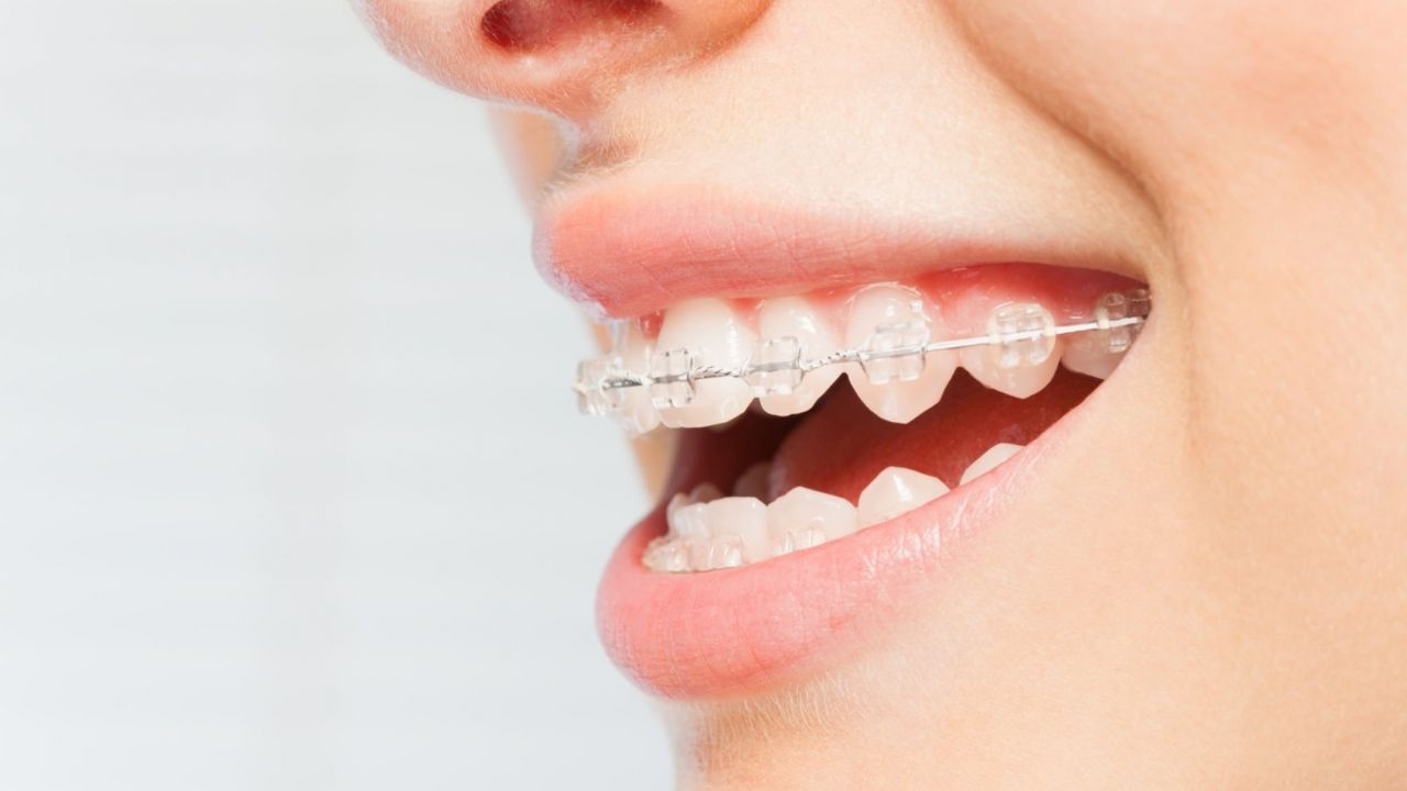 Alinhadores transparentes 😃 O aparelho ortodôntico Invisalign é removível,  confortável, higiênico e quase invisível.…