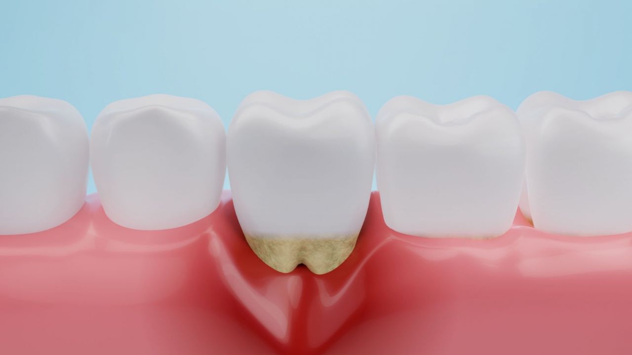 doença periodontal