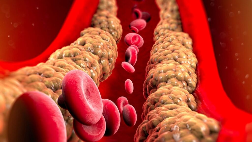 Quais são os sintomas de arteriosclerose? Entenda aqui