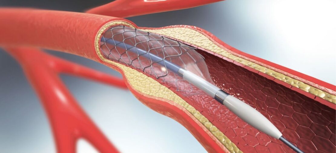 cardiologia bariátrica