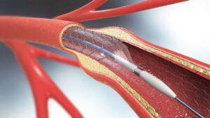 cardiologia bariátrica