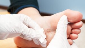 olho de peixe no pé