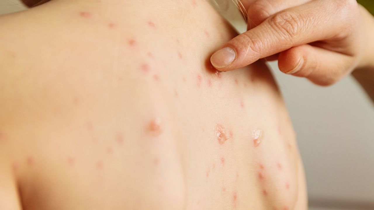 Caroços na pele: doenças relacionadas - Minha Vida