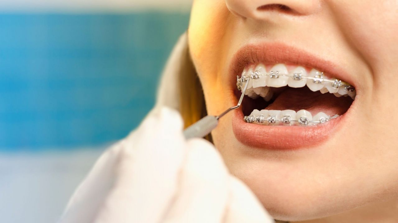 Tratamento Ortodôntico - Salvador Aparelho Ortodontia tratar