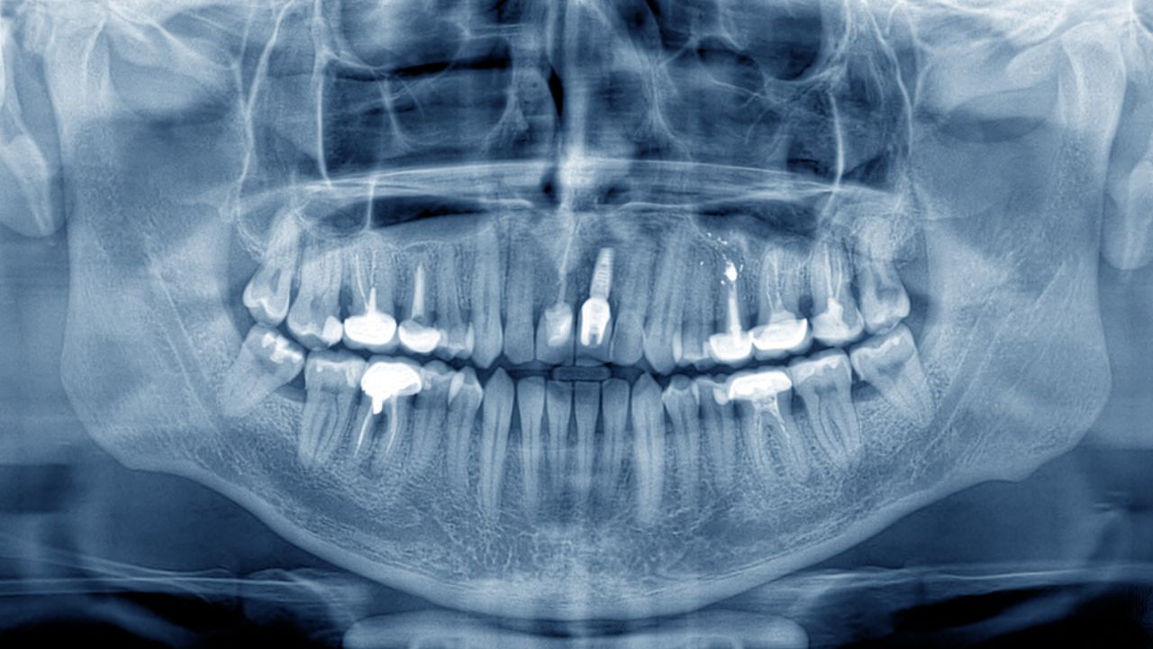 Radiografia Panorâmica da mandíbula não evidencia lesões sugestivas de