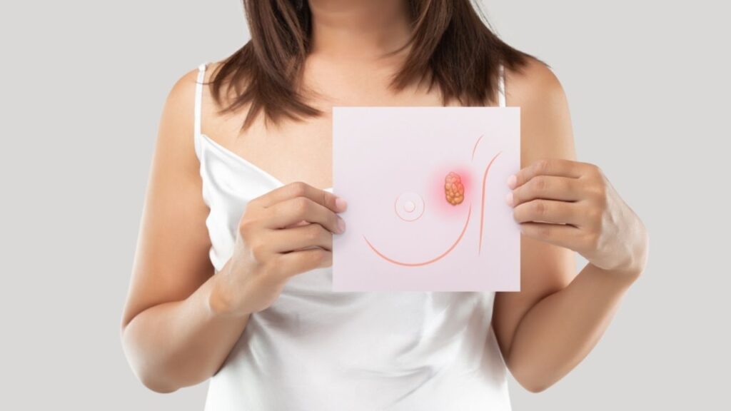 mulher mostrando como é o caroço do câncer de mama