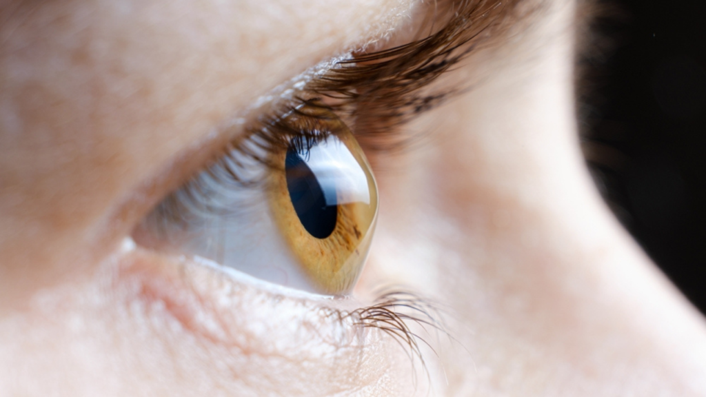 Um olho de paciente que apresenta a condição de ceratocone.