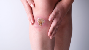 Perna de mulher que sofre pela presença de ferida inflamada.