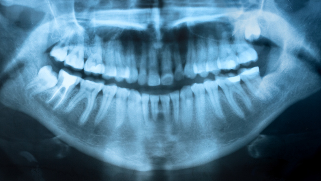 Imagem de exame do raio x panorâmico odontológico.