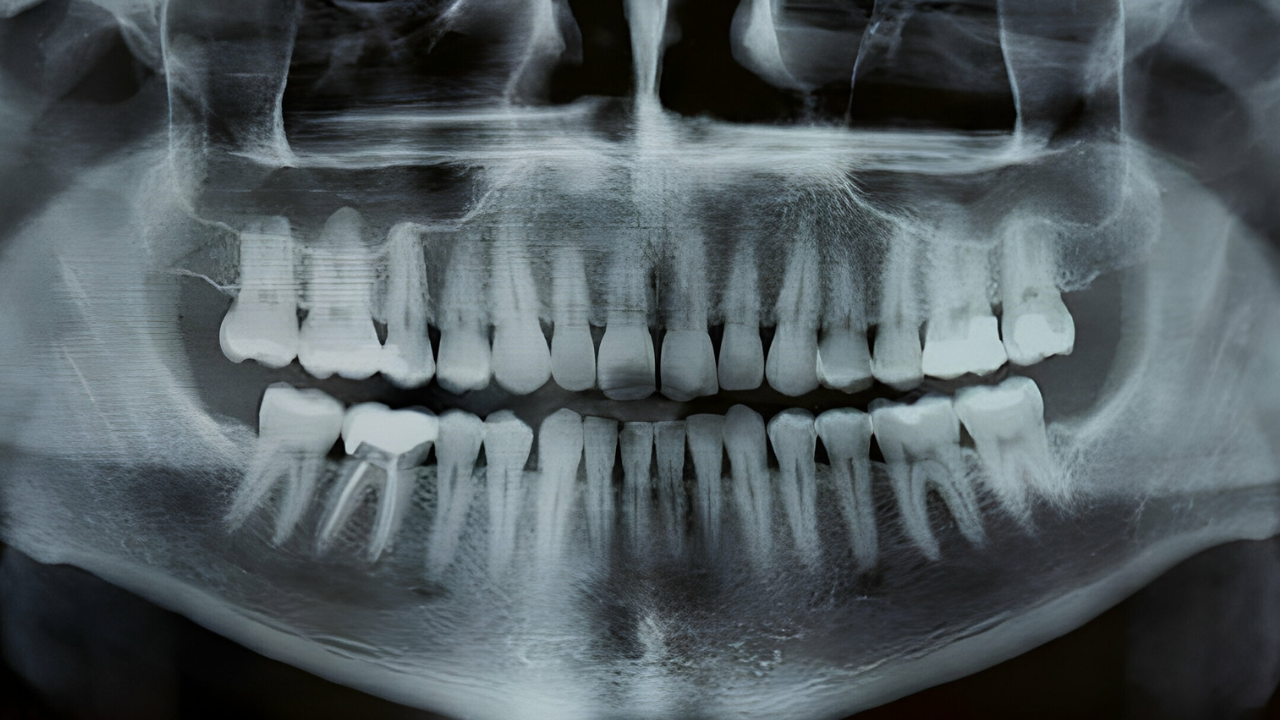 Imagem emitida por um exame de raio x panorâmico odontológico/ (raio x panorâmico valor)