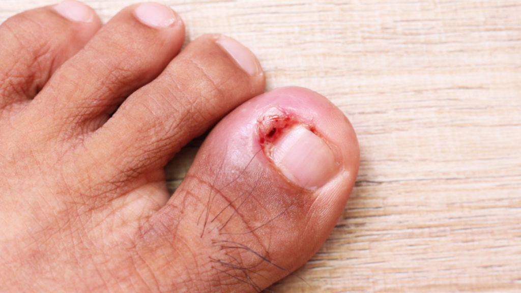 Ferida infeccionada sinais da infecção e tratamentos