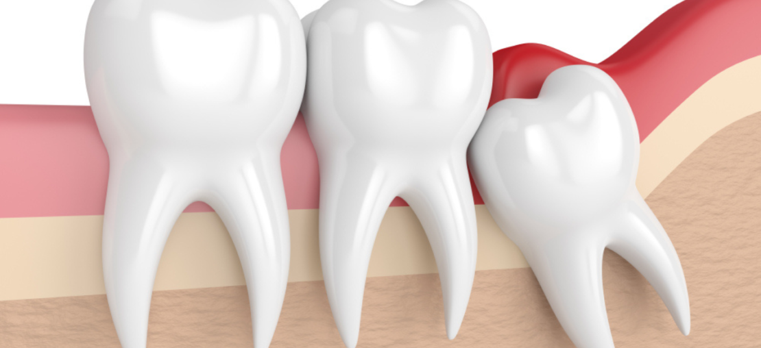 Pericoronarite causada pelo surgimento do dente siso.