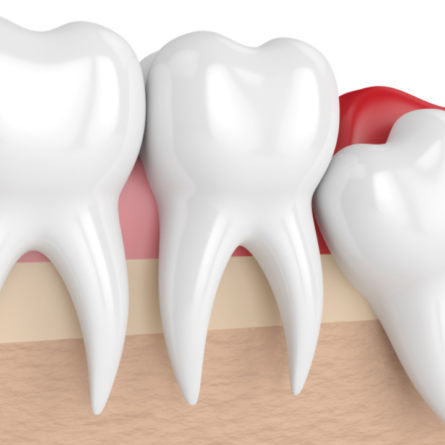 Pericoronarite causada pelo surgimento do dente siso.