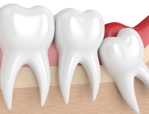 Pericoronarite causada pelo surgimento do dente siso.