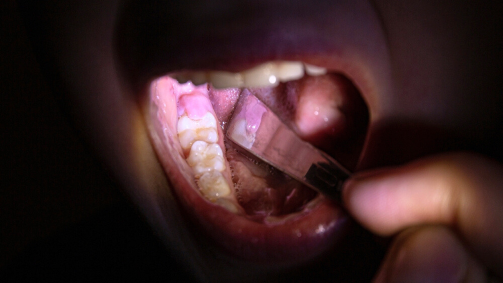 Pericoronarite sintomas, causas e como tratar?