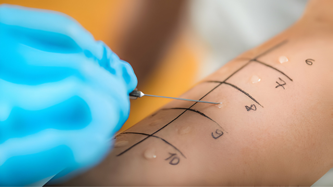 Um médico alergologista realizando Prick test em paciente.