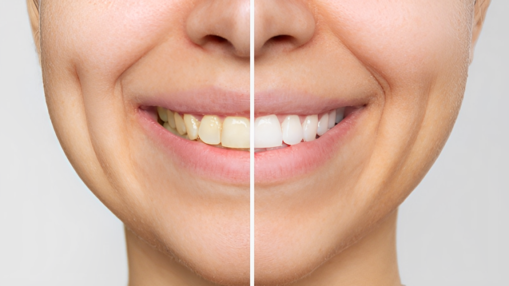 Sorriso mostrando clareamento dental antes e depois