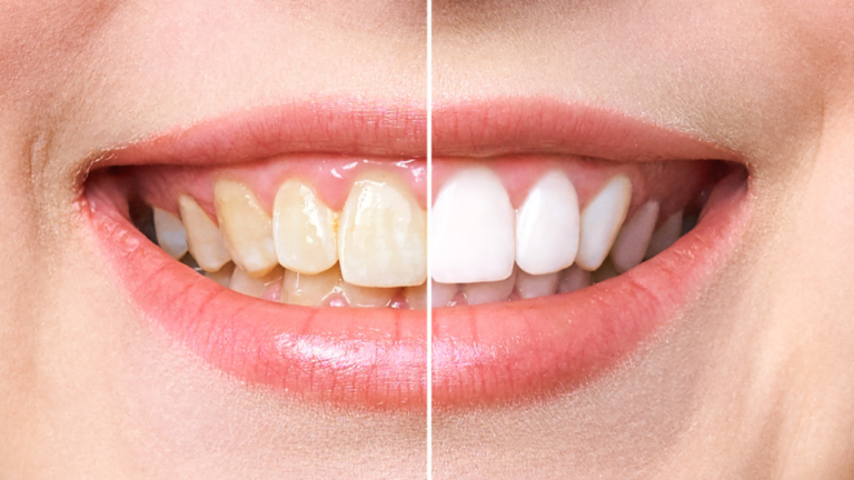 Clareamento dental caseiro: como fazer, custo e melhor opção