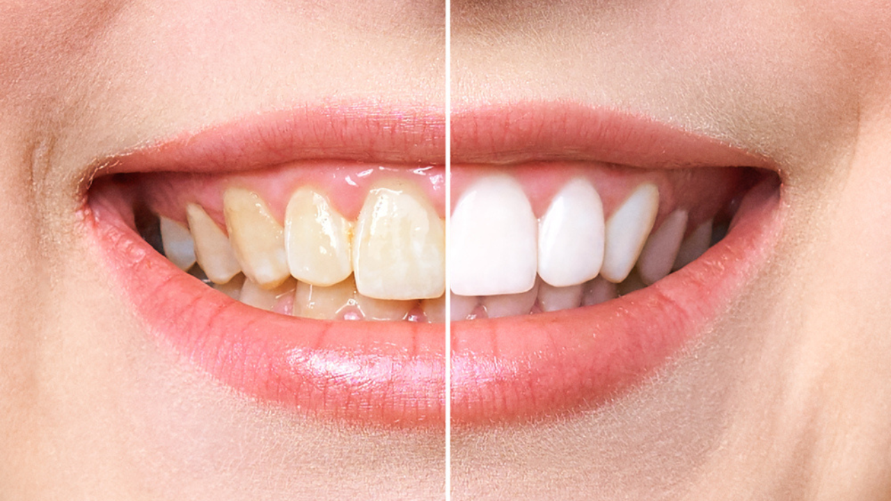 Um antes e depois de dentes que passaram por clareamento dental caseiro