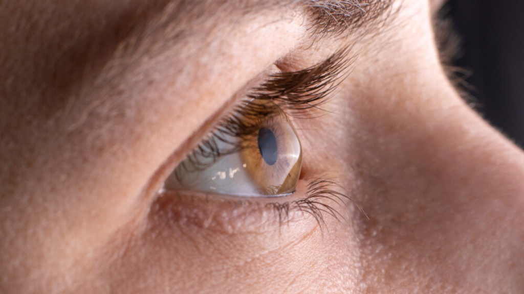 Olhos de uma pessoa com ceratocone /como tratar ceratocone