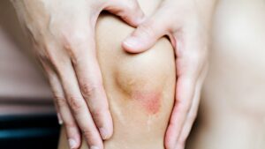 Zoom em joelho com ferida inflamada