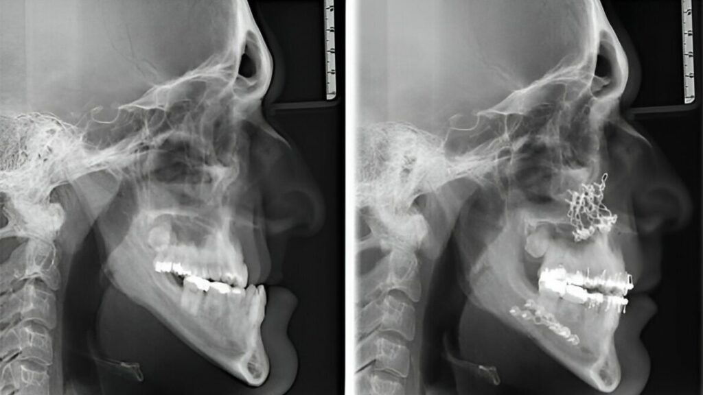 radiografia monstrando resultado de cirurgia ortognática antes e depois