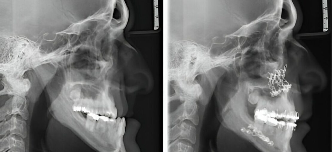 radiografia monstrando resultado de cirurgia ortognática antes e depois