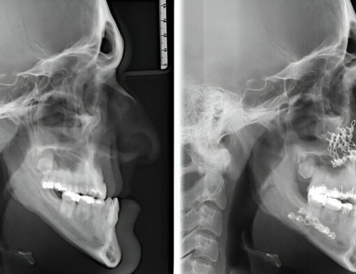 radiografia monstrando resultado de cirurgia ortognática antes e depois