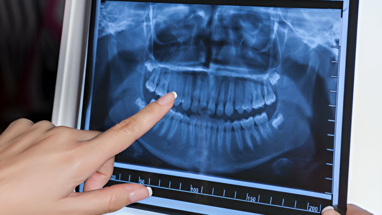 radiografia mostrando dentição de paciente de cirurgia ortognática