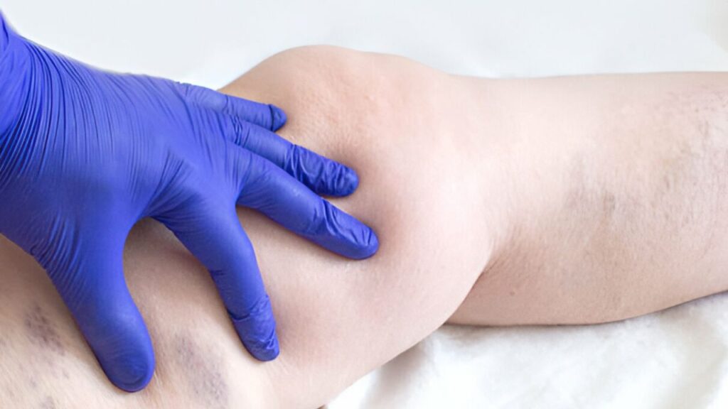 Imagem de médico avaliando mancha deixada por flebite em coxa de paciente