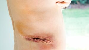 Zoom em hérnia incisional