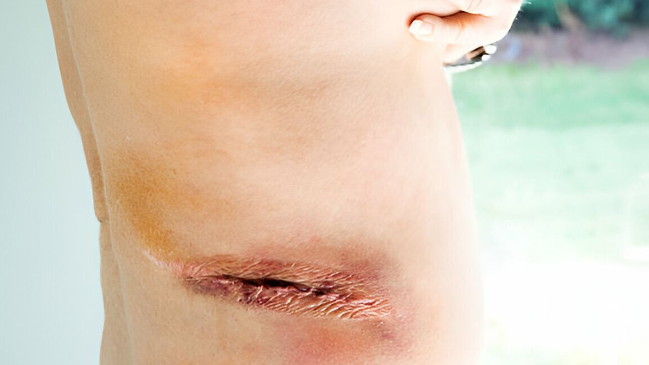 Zoom em hérnia incisional