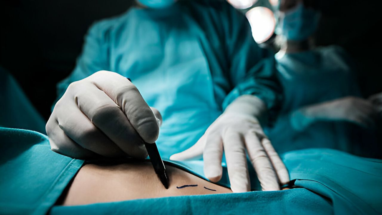 Zoom em cirurgião plástico fazendo marcação na barriga de paciente para inicio de cirurgia