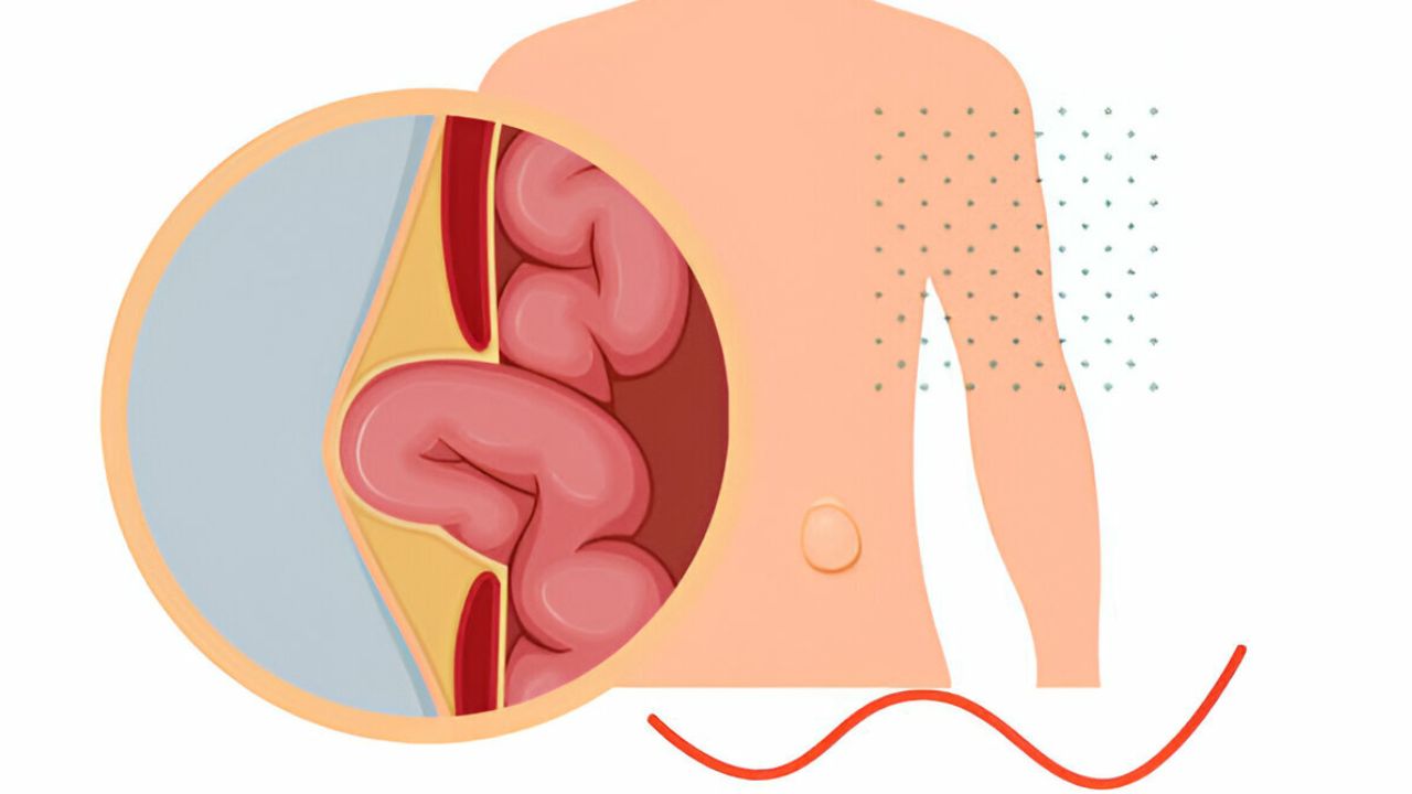 Ilustração demostrando protuberância da hérnia inguinal no intestino