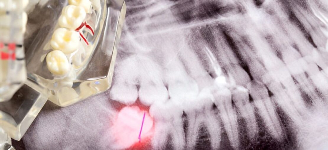 Molde de arcada dentária sobre raio-x evidenciando problema de pericoronarite em sisos
