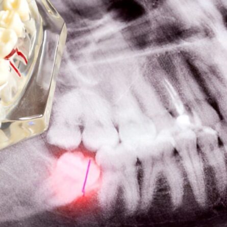 Molde de arcada dentária sobre raio-x evidenciando problema de pericoronarite em sisos