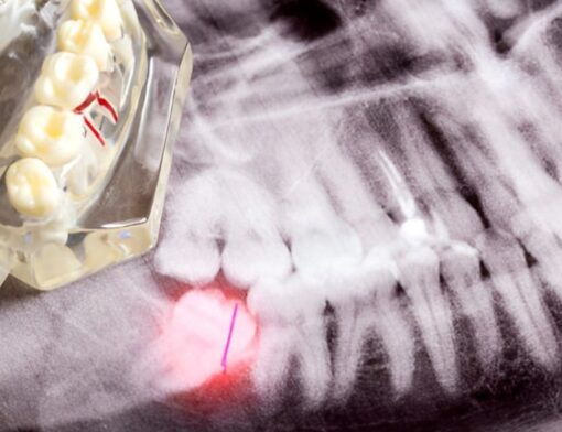 Molde de arcada dentária sobre raio-x evidenciando problema de pericoronarite em sisos