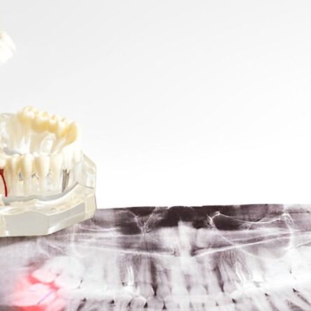 Molde de arcada dentária sobre raio-x odontológico evidenciando nascimento de dentes sisos