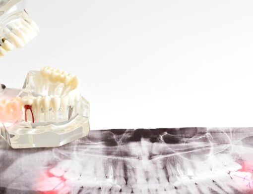 Molde de arcada dentária sobre raio-x odontológico evidenciando nascimento de dentes sisos