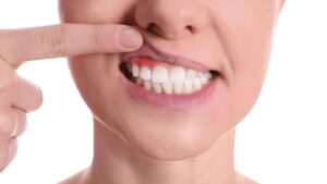 Zoom em mulher mostrando gengiva inchada e avermelhada por conta da periodontite avançada