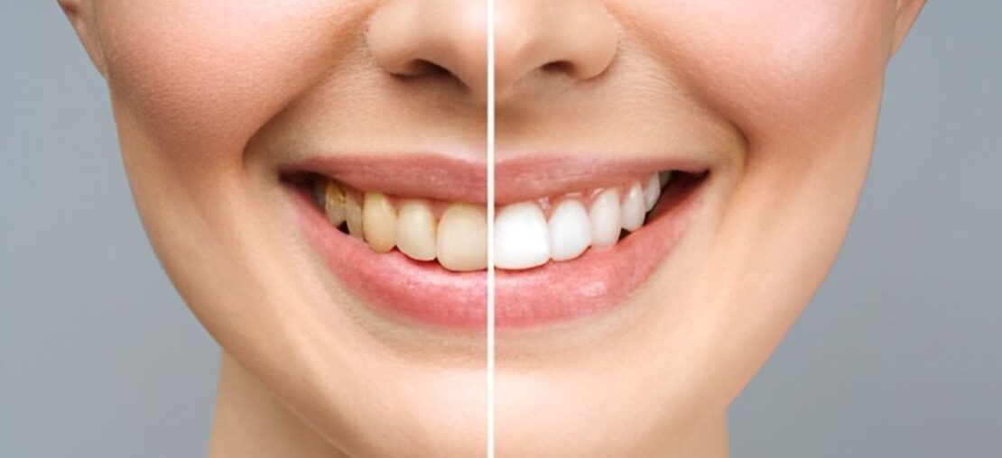 Imagem mostrando antes e depois de sorriso de clareamento dental