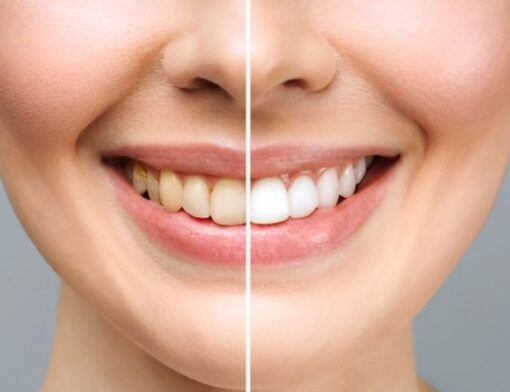 Imagem mostrando antes e depois de sorriso de clareamento dental