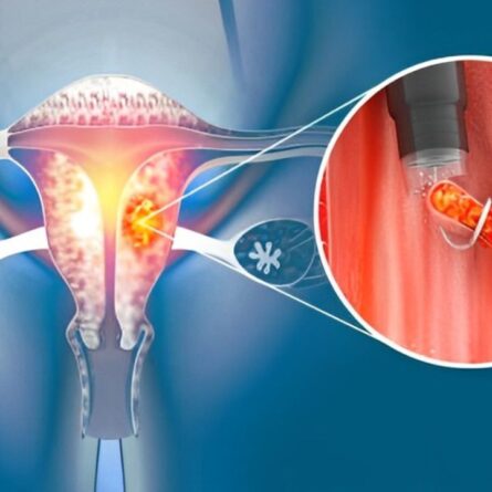 Ilustração representando pólipo endometrial