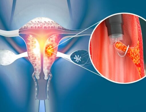 Ilustração representando pólipo endometrial