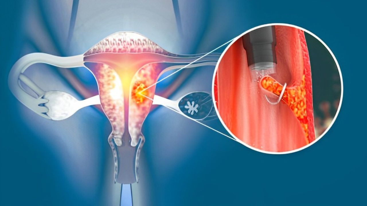 Sintomas De Pólipo Endometrial Saiba Identificar E Tratar 7952