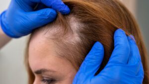 Como lidar com a perda de cabelo