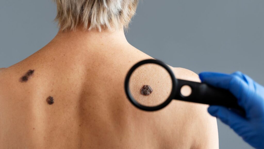 Prevenção dos tipos de câncer de pele