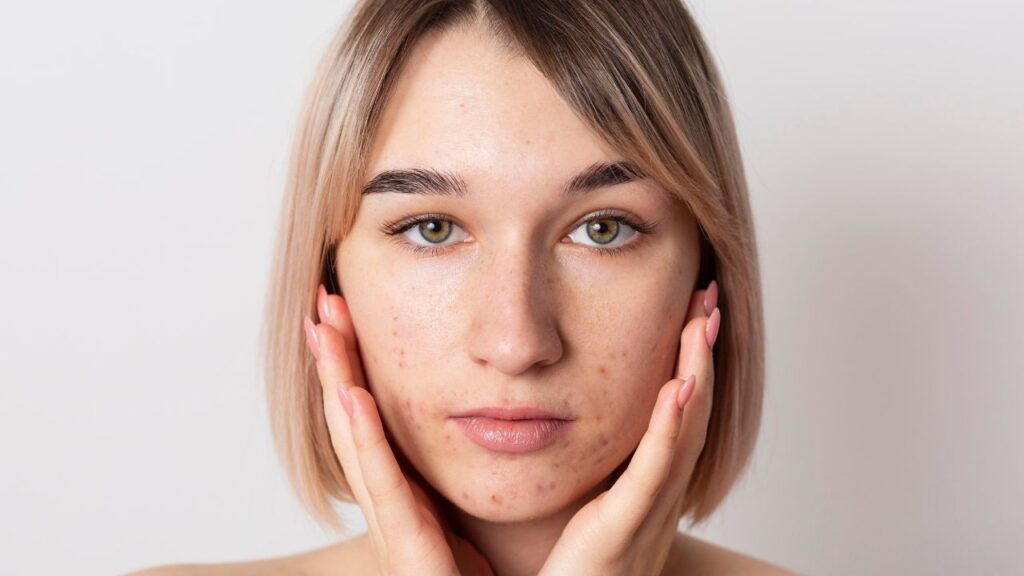 Como acabar com espinhas